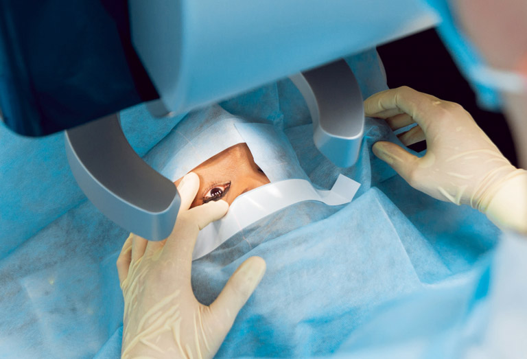 La chirurgie oculaire pour traiter les troubles de la vision