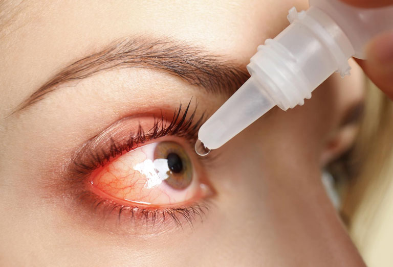 Kératite : comprendre cette inflammation de la cornée