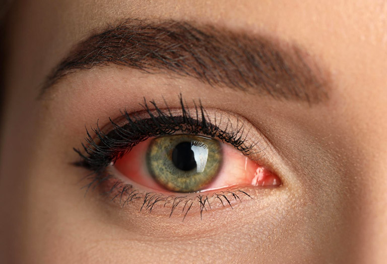 Conjonctivite : causes, symptômes et traitement